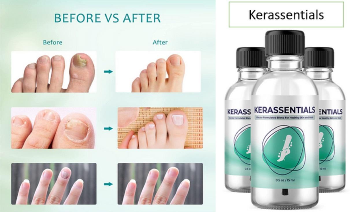 #Kerassentials #Reviews Nails And Skin Fungus Treatment Supplement! Does It Work