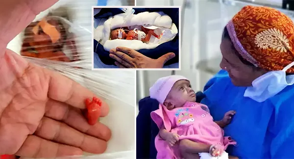 A Little Fighter Baby Girl Born 3 Months Premature Weighs Less Than a Chocolate Bar.