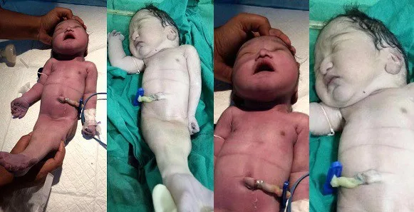 Speculation is swirling as many people believe that this newborn in India might be the country's first-ever mermaid